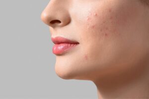 Leia mais sobre o artigo Segredo das Celebridades: Como Clarear Manchas de Acne em Casa